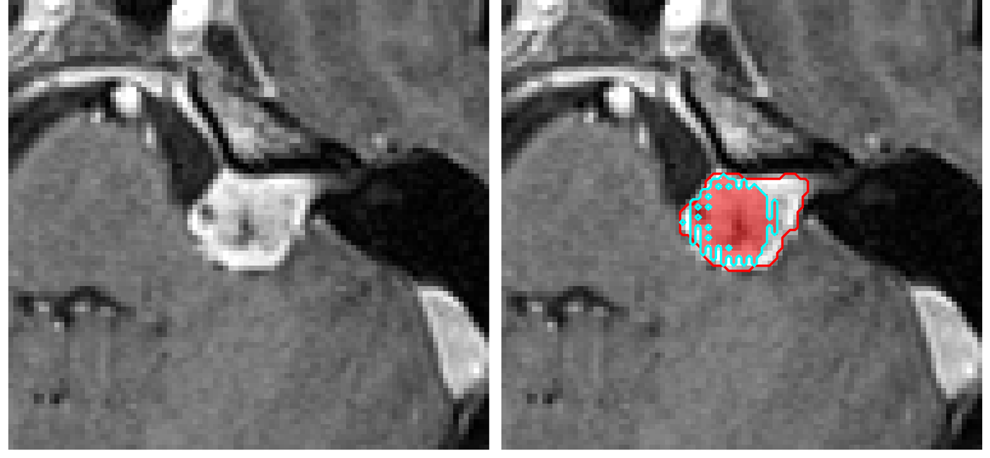 Cognia segmentation on brain MRI, expert outline in red, model in cyan